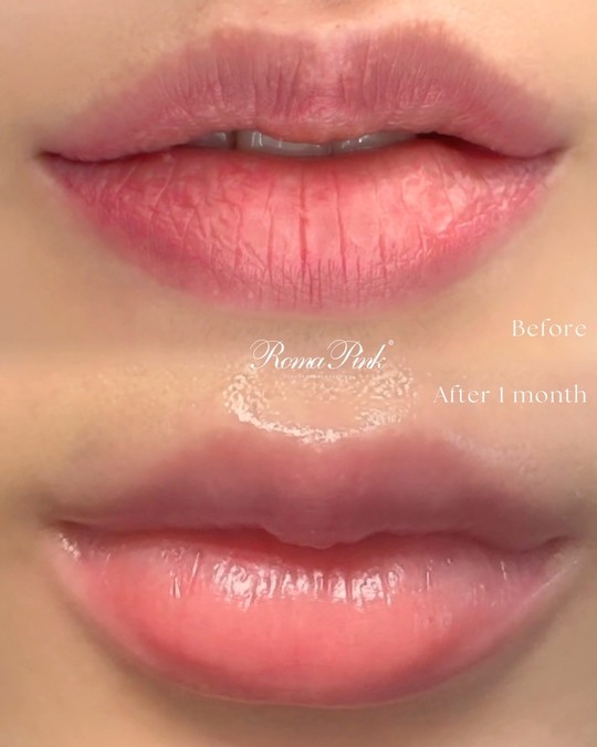 ローマピンク - 石巻脱毛・エステサロン│LUXE（リュクス）