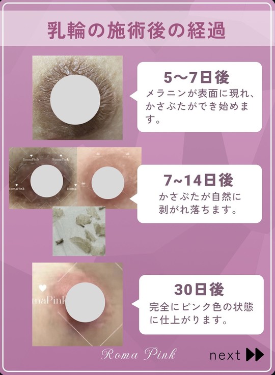 ローマピンク - 石巻脱毛・エステサロン│LUXE（リュクス）